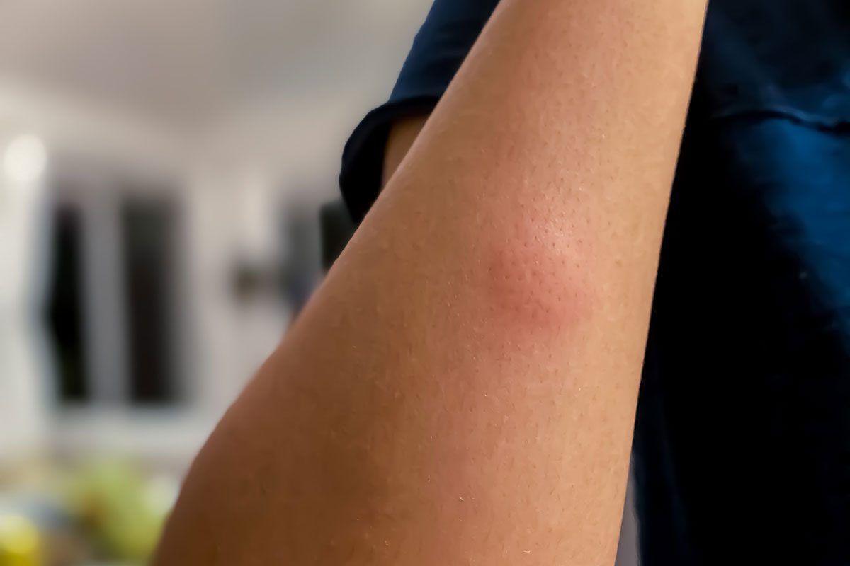 Ani komár, ani vosa: nejstrašnější kousnutí zvířete v létě, jak ho rozpoznat